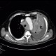 Lung cancer, infiltration of lung wing, metastasis in neuroforamina: CT - Computed tomography